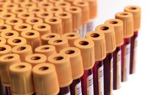 HIV blood samples
