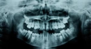 teeth xray